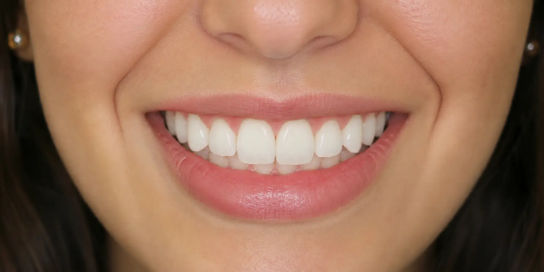 Invisalign after result