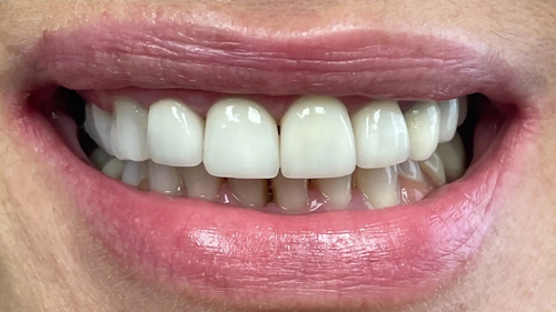 Invisalign after result