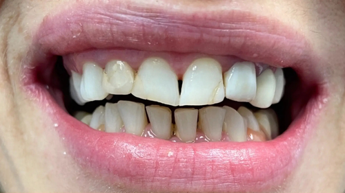 Invisalign before result