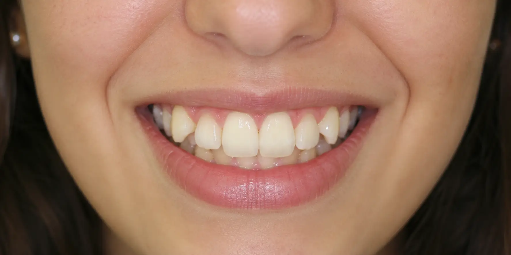 Invisalign before result